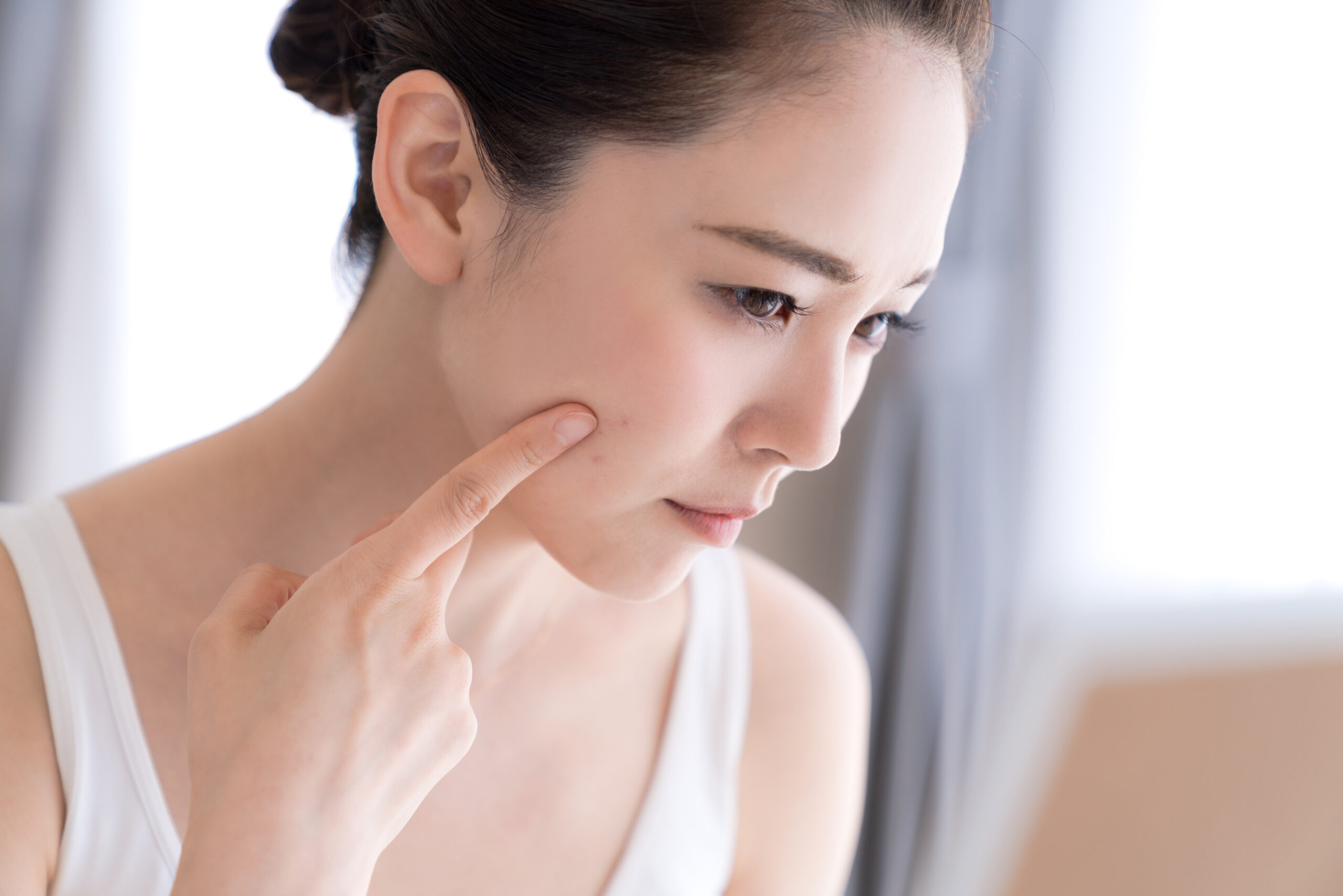 スキンケア変更後のニキビは好転反応 アレルギーや肌荒れとの違いは 美容家ドットコム